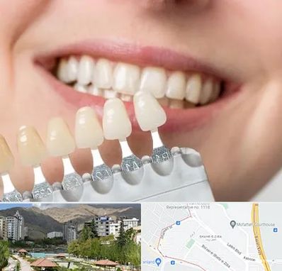 مرکز کامپوزیت دندان در شهر زیبا