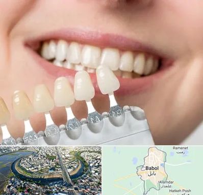 مرکز کامپوزیت دندان در بابل