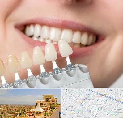 مرکز کامپوزیت دندان در هاشمیه مشهد
