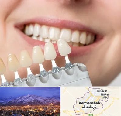 مرکز کامپوزیت دندان در کرمانشاه