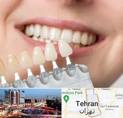 مرکز کامپوزیت دندان در صادقیه تهران