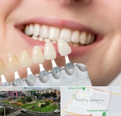 مرکز کامپوزیت دندان در تهرانسر