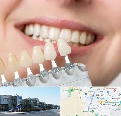 مرکز کامپوزیت دندان در شریعتی مشهد
