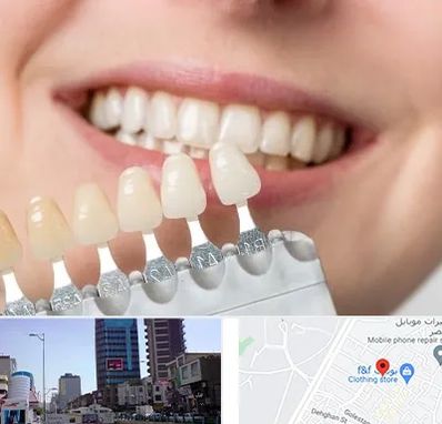 مرکز کامپوزیت دندان در چهارراه طالقانی کرج