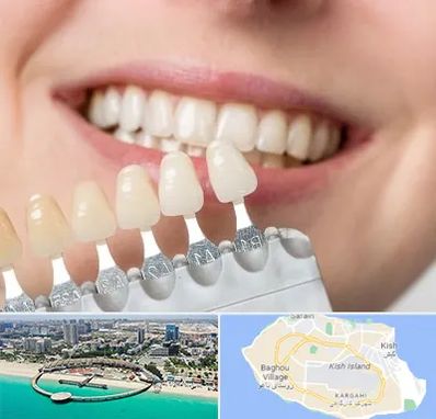 مرکز کامپوزیت دندان در کیش
