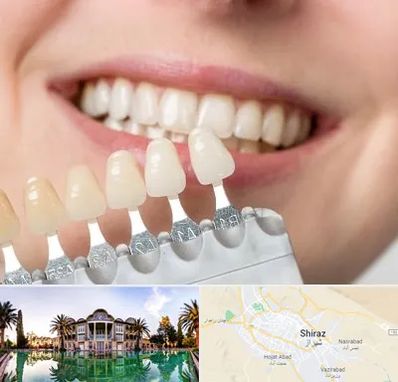 مرکز کامپوزیت دندان در شیراز