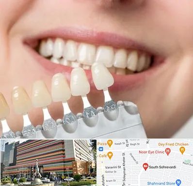 مرکز کامپوزیت دندان در سهروردی