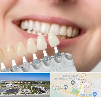 مرکز کامپوزیت دندان در ملارد