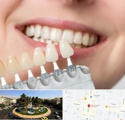 مرکز کامپوزیت دندان در هفت حوض