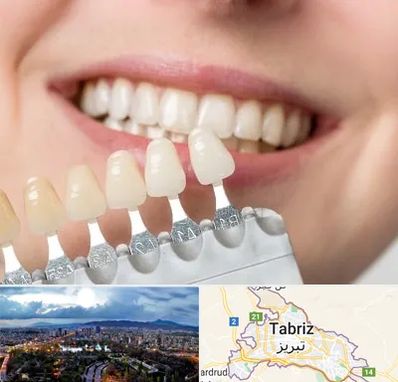 مرکز کامپوزیت دندان در تبریز