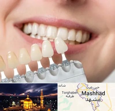 مرکز کامپوزیت دندان در مشهد