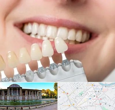 مرکز کامپوزیت دندان در عفیف آباد شیراز