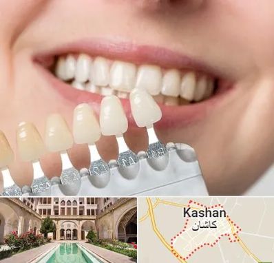 مرکز کامپوزیت دندان در کاشان