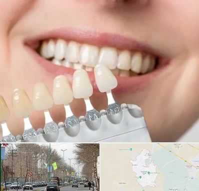 مرکز کامپوزیت دندان در نظرآباد کرج