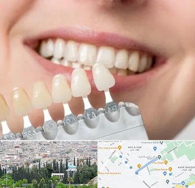 مرکز کامپوزیت دندان در محلاتی شیراز