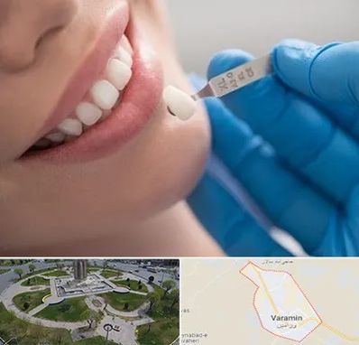 مرکز لمینت دندان در ورامین