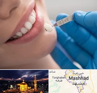 مرکز لمینت دندان در مشهد