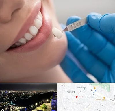 مرکز لمینت دندان در هفت تیر مشهد