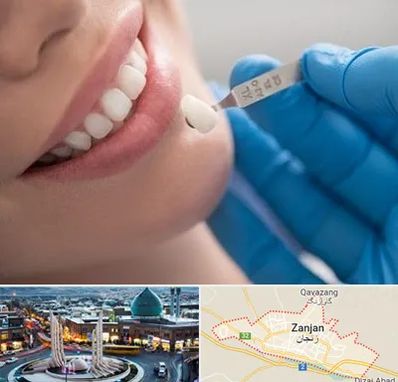 مرکز لمینت دندان در زنجان