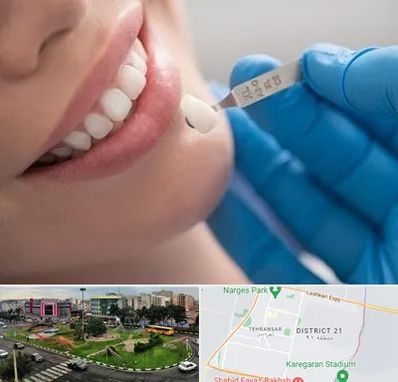 مرکز لمینت دندان در تهرانسر