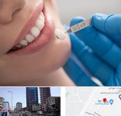 مرکز لمینت دندان در چهارراه طالقانی کرج