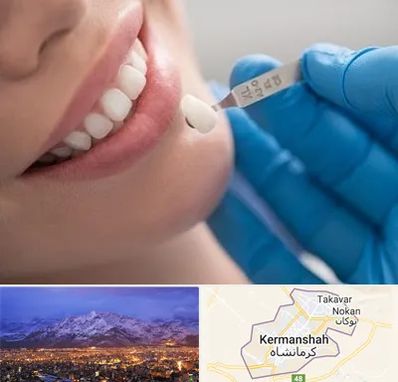 مرکز لمینت دندان در کرمانشاه