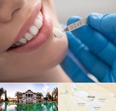 مرکز لمینت دندان در شیراز