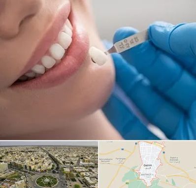 مرکز لمینت دندان در قزوین