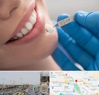 مرکز لمینت دندان در بلوار توس مشهد