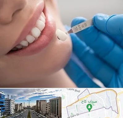مرکز لمینت دندان در سعادت آباد تهران