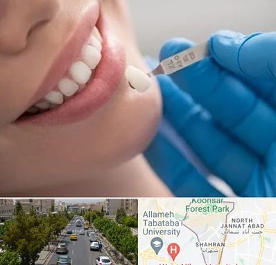 مرکز لمینت دندان در شهران