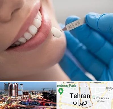 مرکز لمینت دندان در صادقیه تهران