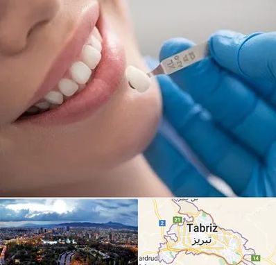 مرکز لمینت دندان در تبریز