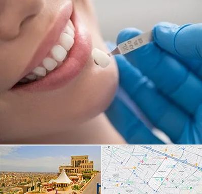 مرکز لمینت دندان در هاشمیه مشهد