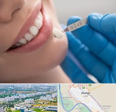 مرکز لمینت دندان در آبادان