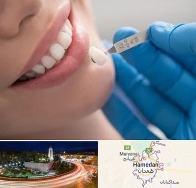 مرکز لمینت دندان در همدان
