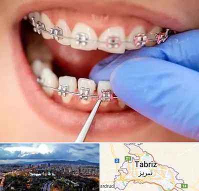 مرکز ارتودنسی دندان در تبریز