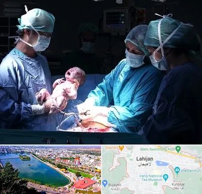 جراح سزارین در لاهیجان