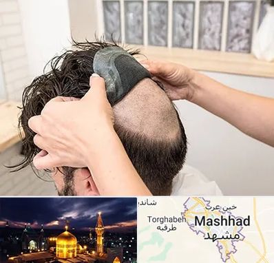پروتز مو در مشهد