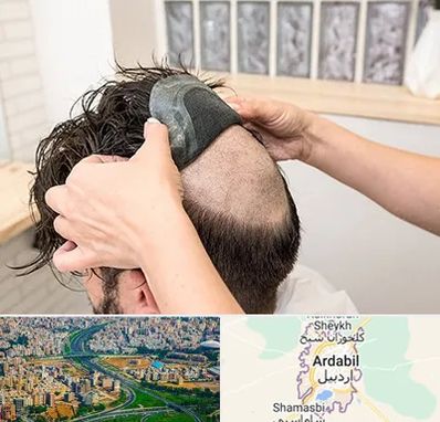 پروتز مو در اردبیل