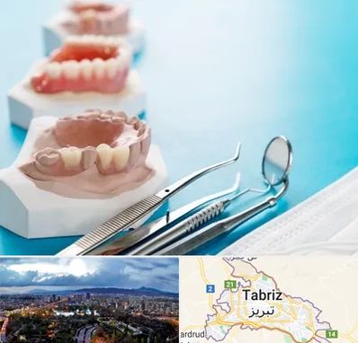 متخصص روکش دندان در تبریز