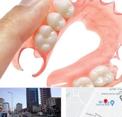 پروتز متحرک دندان در چهارراه طالقانی کرج 