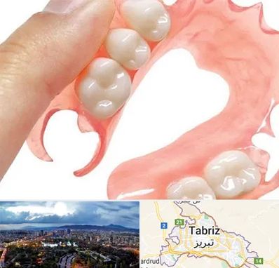پروتز متحرک دندان در تبریز