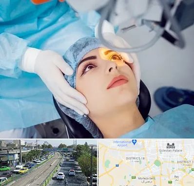 دکتر عمل لیزیک چشم در جنوب تهران