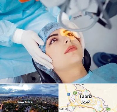 دکتر عمل لیزیک چشم در تبریز