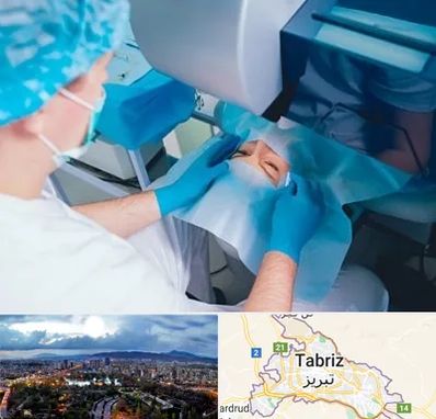 دکتر عمل لازک چشم در تبریز