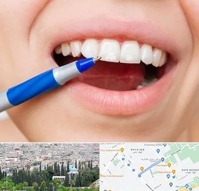 دندانسازی ارزان در محلاتی شیراز 