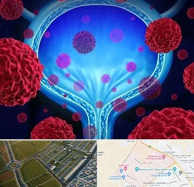 دکتر سرطان مثانه در الهیه مشهد 