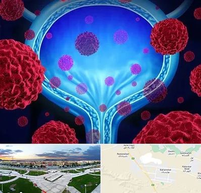 دکتر سرطان مثانه در بهارستان اصفهان 