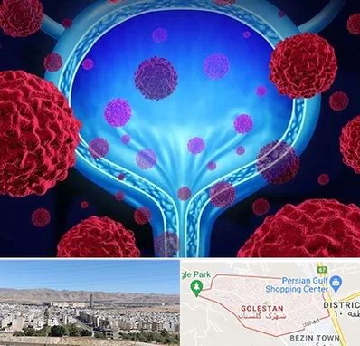 دکتر سرطان مثانه در شهرک گلستان شیراز 